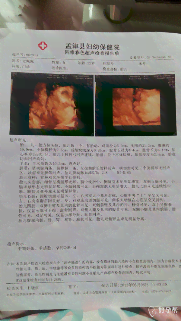 四维彩超照片是合成的吗：如何判断其真实性及与出生后对比