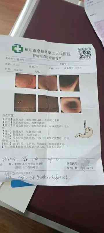 胃镜报告写着非萎缩性胃炎,但病理有肠化：严重程度及意义解析