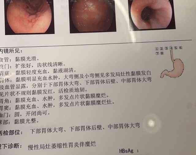 胃镜报告写着病理随访密切什么意思：详解胃镜随访与读懂病理报告的含义