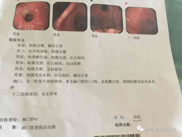 胃镜报告写着病理随访密切什么意思：详解胃镜随访与读懂病理报告的含义