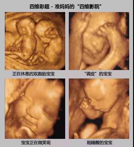 宝宝四维彩超照片分享：精选朋友圈文案及配图建议指南