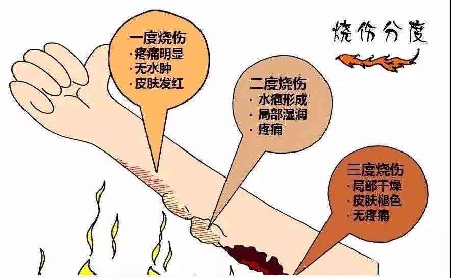 轻度烫伤是否构成工伤认定标准探讨