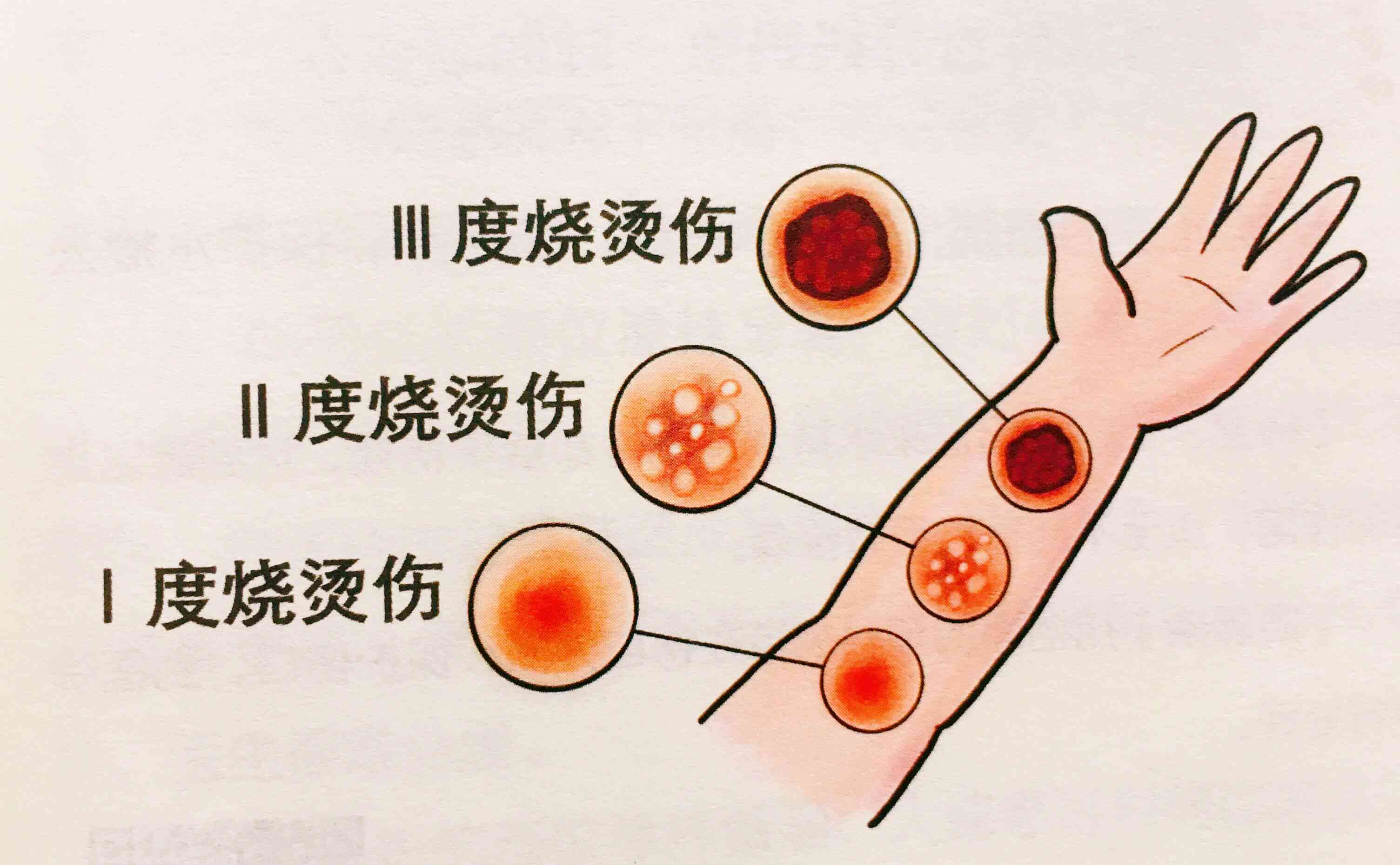 一度烫伤是否构成轻伤害及其法律界定与处理指南