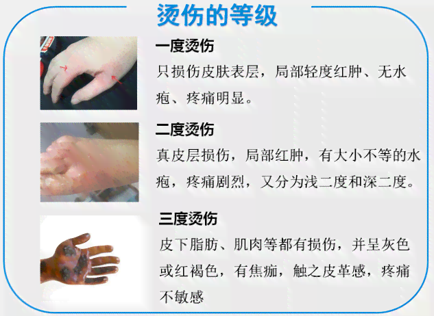 一度烫伤是否构成轻伤害及其法律界定与处理指南