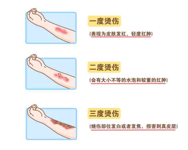 一度烫伤是否构成轻伤害及其法律界定与处理指南