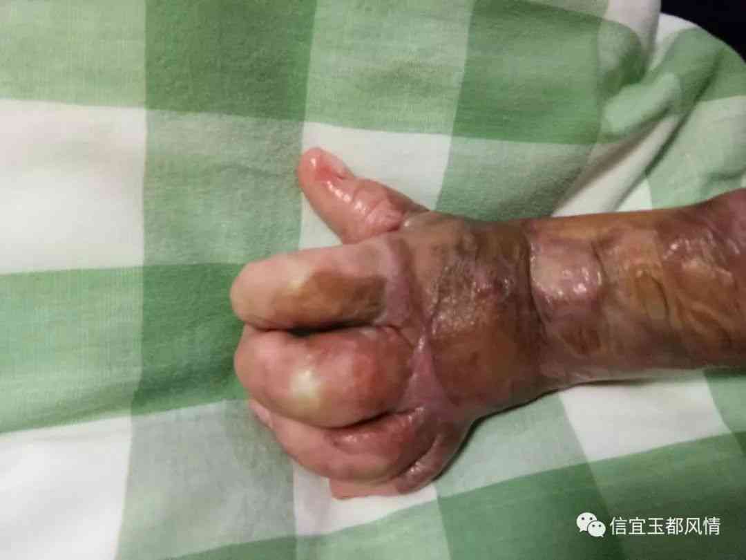 一度烫伤能自愈吗：女生是否会留疤，能否恢复原样？