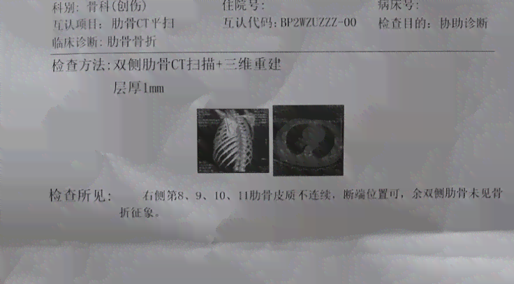 '三根肋骨骨折工伤等级判定标准解析'
