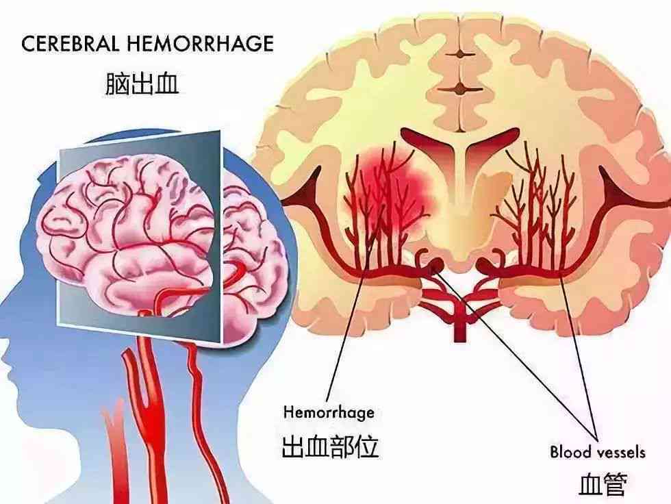 工作中突发脑淤血惊险一幕