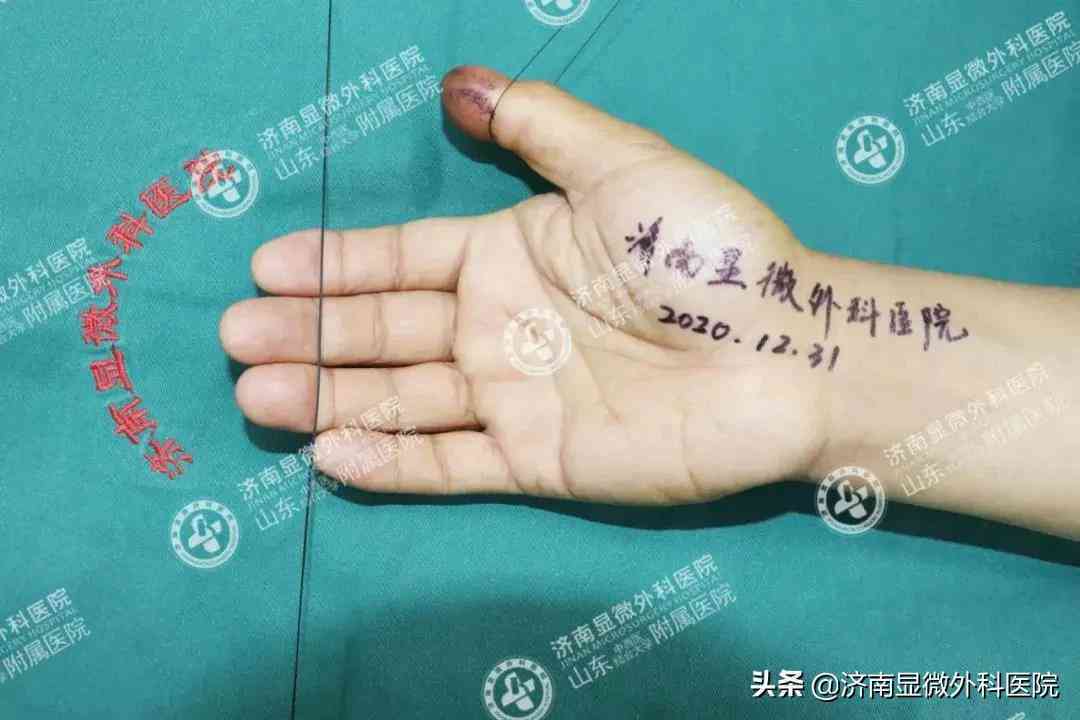手指在工作中挤伤能否被认定为工伤及赔偿标准解析