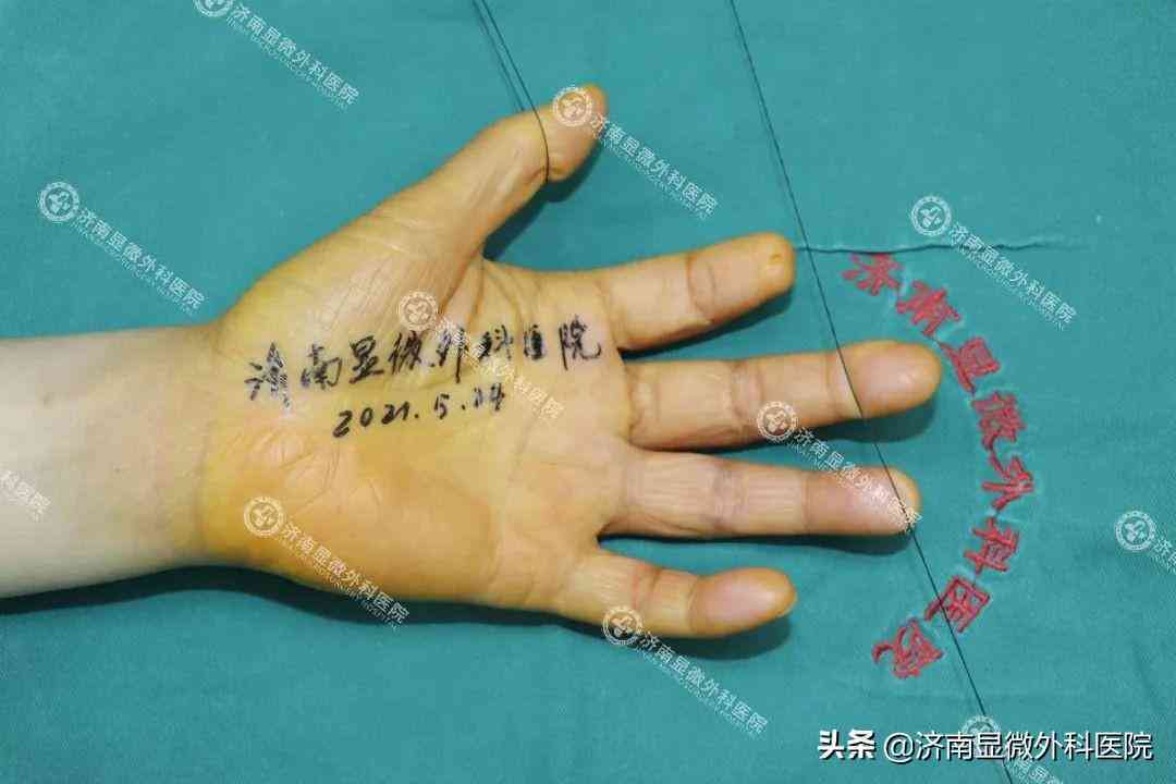 手指在工作中挤伤能否被认定为工伤及赔偿标准解析