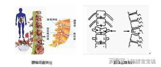 腰椎损伤不包括在工伤认定的七种典型情形中