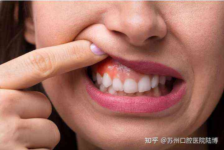 两颗门牙松动了要拔掉吗？原因、处理方法及费用解析
