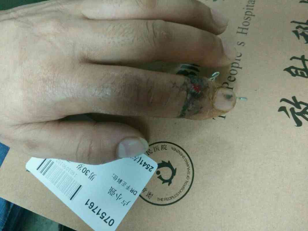 中指失去功能认定工伤几级