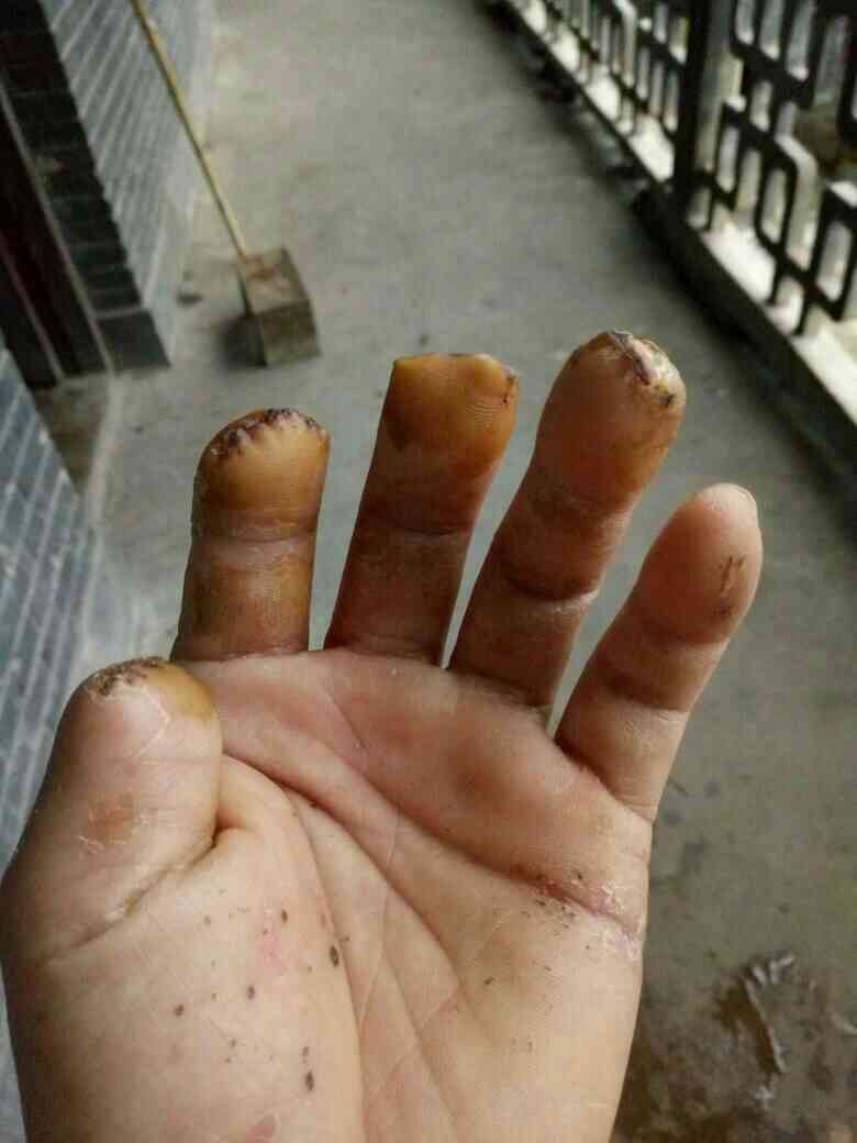 工伤致中指截肢赔偿标准及赔偿流程详解
