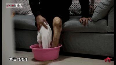 一节半中指截肢所致伤残级别评定与影响
