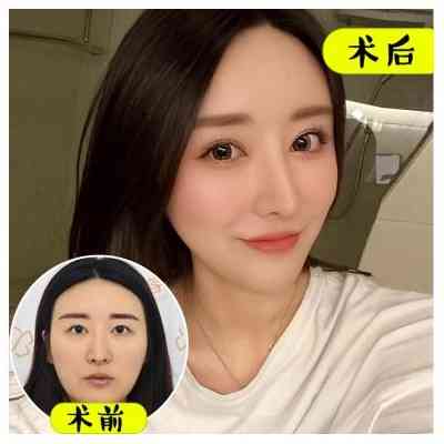 告别眼袋前后对比照，见证眼部年轻化奇迹