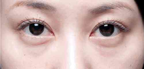 告别眼袋前后对比照，见证眼部年轻化奇迹