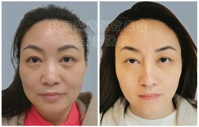 全方位眼袋改善效果对比：告别眼袋，见证肌肤焕新之旅