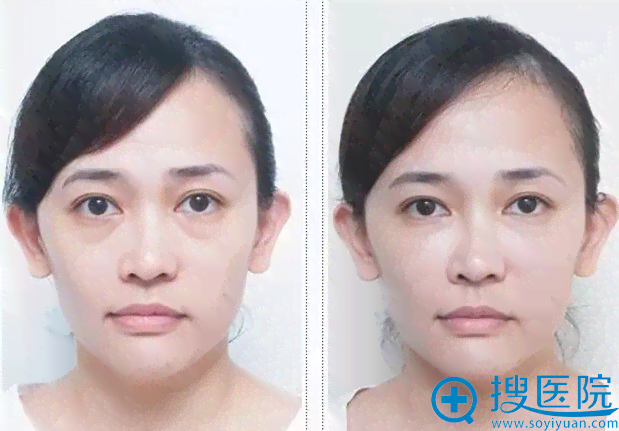 全方位眼袋改善效果对比：告别眼袋，见证肌肤焕新之旅