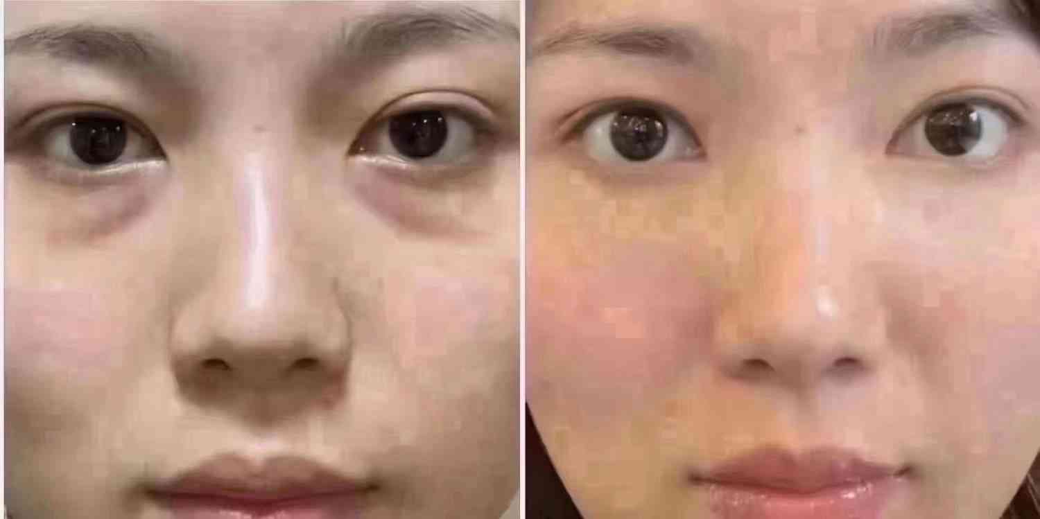 全方位眼袋改善效果对比：告别眼袋，见证肌肤焕新之旅