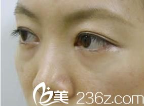 眼袋修复术前术后对比照片展示