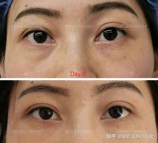 眼袋修复术前术后对比照片展示