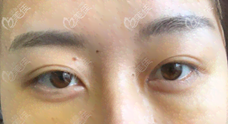 眼袋修复术前术后对比照片展示