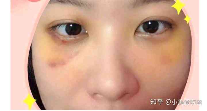 眼袋修复术前术后对比照片展示