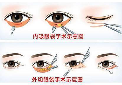 眼袋修复术前术后对比照片展示