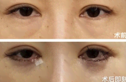 眼袋修复术前术后对比照片展示