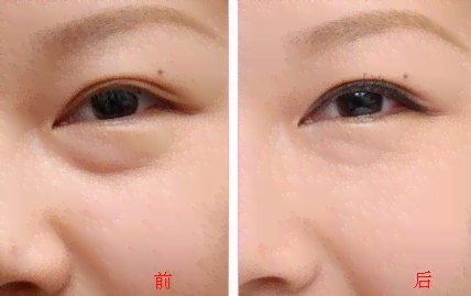 眼袋修复术前术后对比照片展示