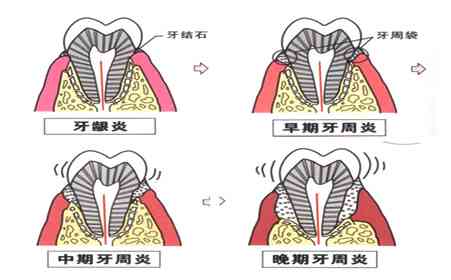 疝气为什么得：成因、为何掉落、增大及不自愈解析