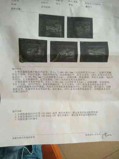 乳腺结节入职：体检影响、被拒责任解析及女性通过率