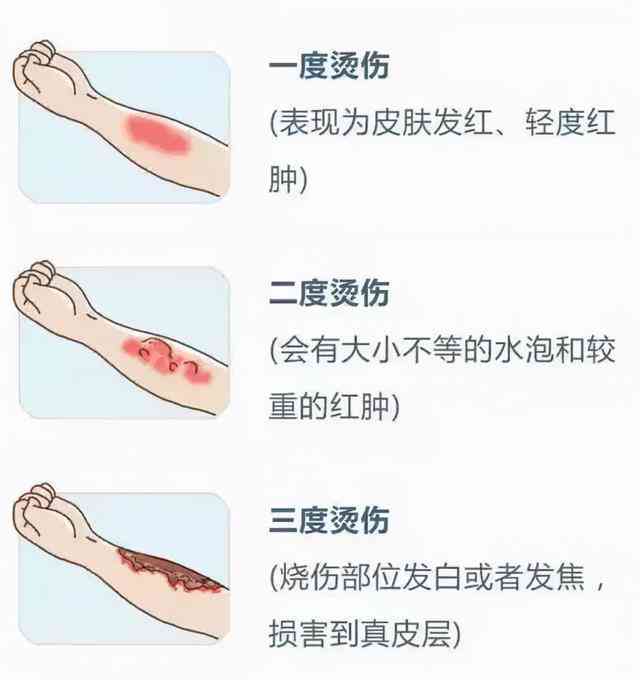 深入了解：如何界定不同程度的烫伤标准与分类