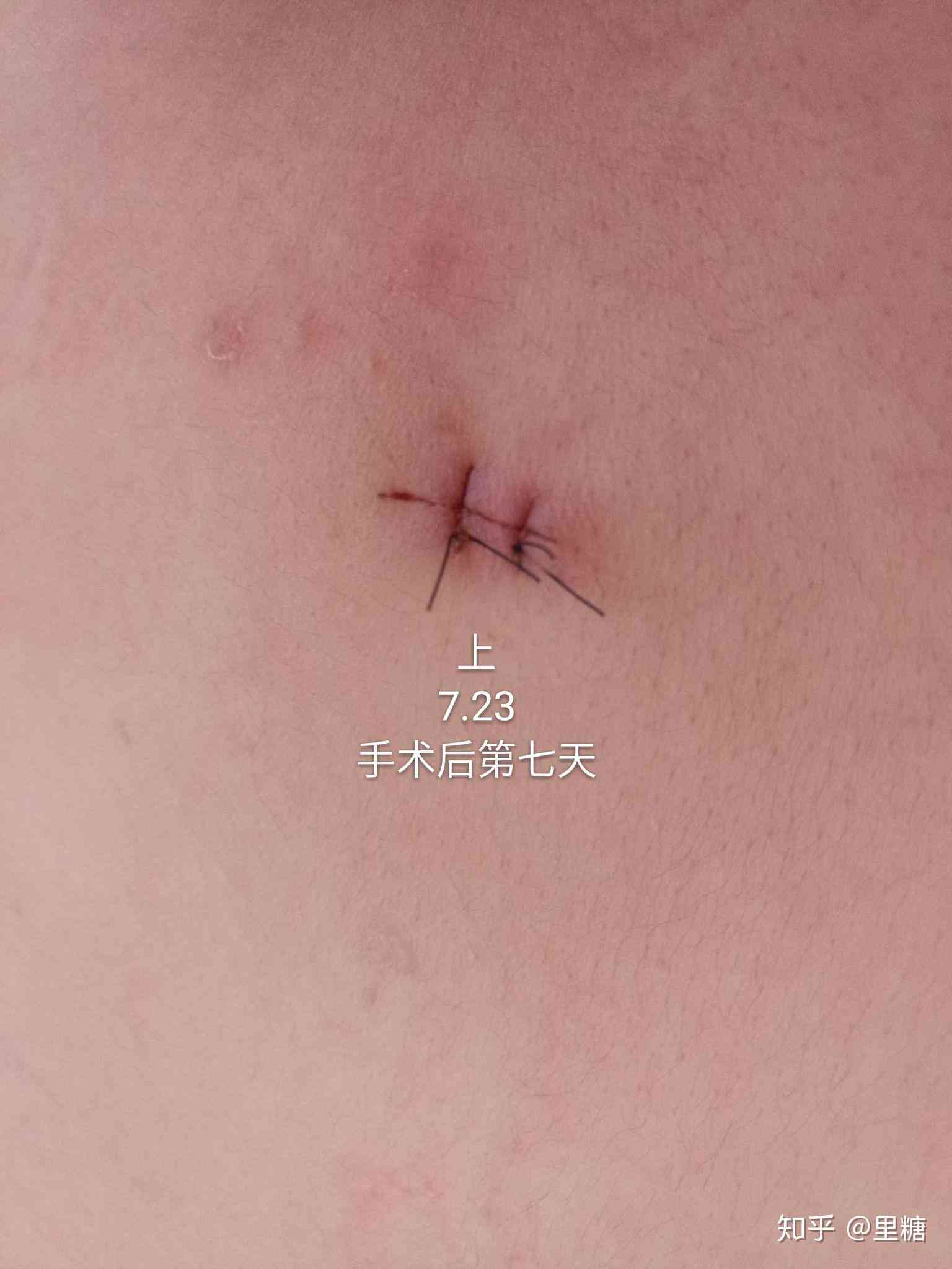 '术后拆线指南：伤口缝针后具体多久可以安全拆线'