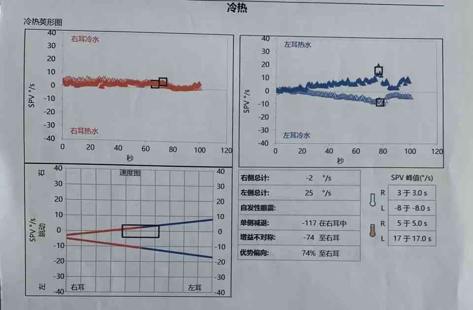 纯音测听报告ai是什么意思