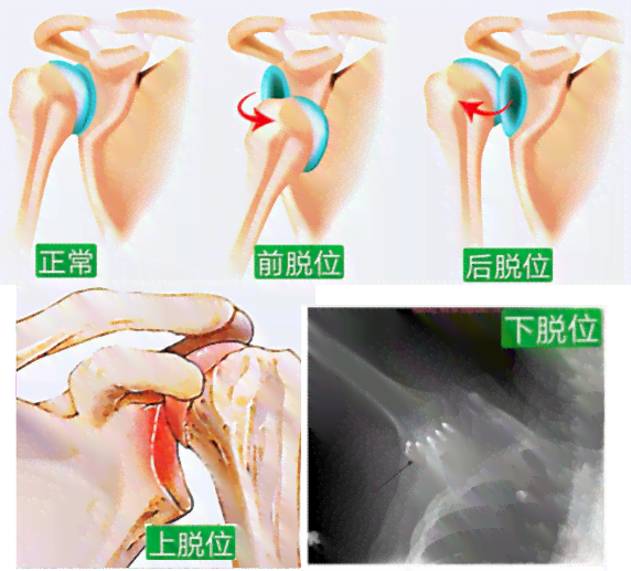 关节脱位算伤残吗：详解关节脱位伤残鉴定标准与法律判定