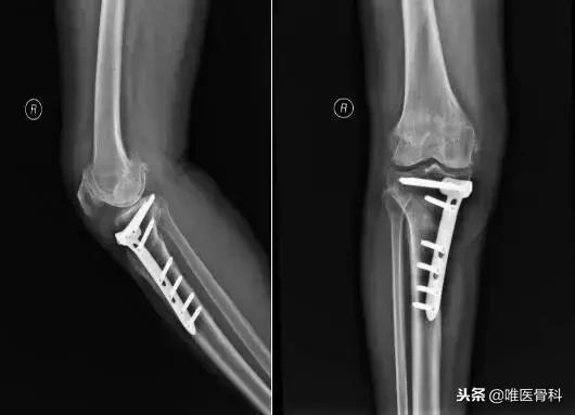 工伤引起的创伤性关节炎认定及赔偿标准详解：全面解析鉴定流程与赔偿项目