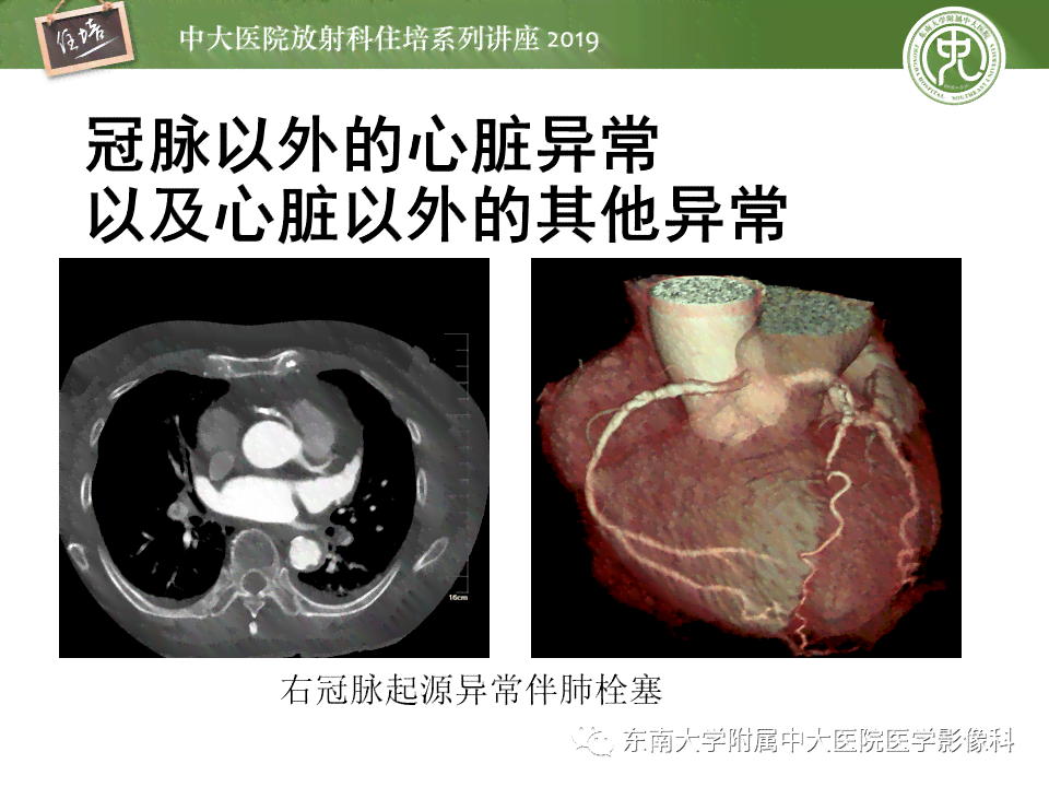 半月板劳损工伤认定全解析：如何判断与申请流程详解