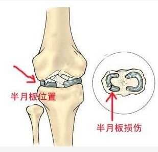 半月板损伤可以申请工伤吗：赔偿标准及评残资格解析