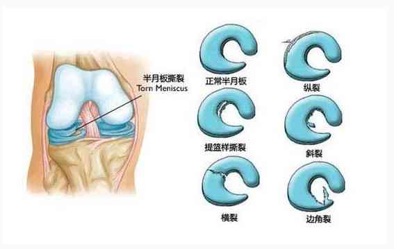 工作中半月板损伤是否合工伤认定标准