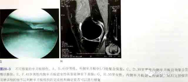 半月板损伤五年后病情发展趋势及手术必要性评估：了解长期影响与治疗选择
