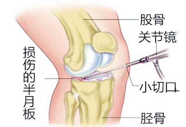 半月板损伤五年能恢复吗：治疗费用、手术必要性及恢复情况探讨