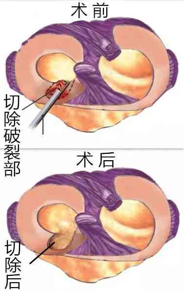 半月板损伤认定工伤吗