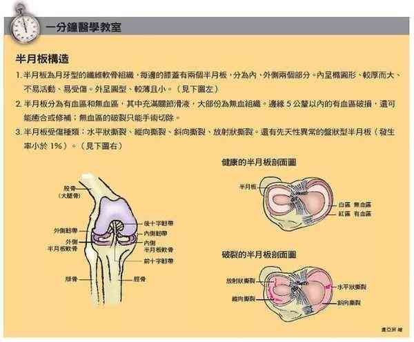 全面指南：半月板损伤工伤认定流程、所需材料及注意事项