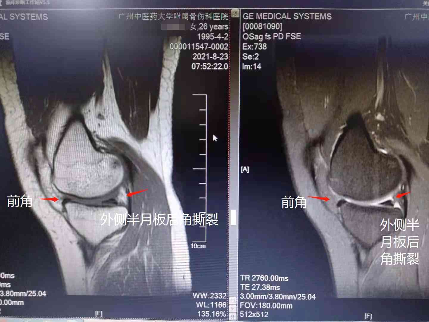 半月板损做手术认定工伤伤残等级及鉴定标准注意事项