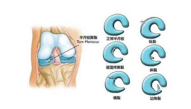 半月板撕裂做手术了能认定工伤吗及赔偿金额与工伤级别判定
