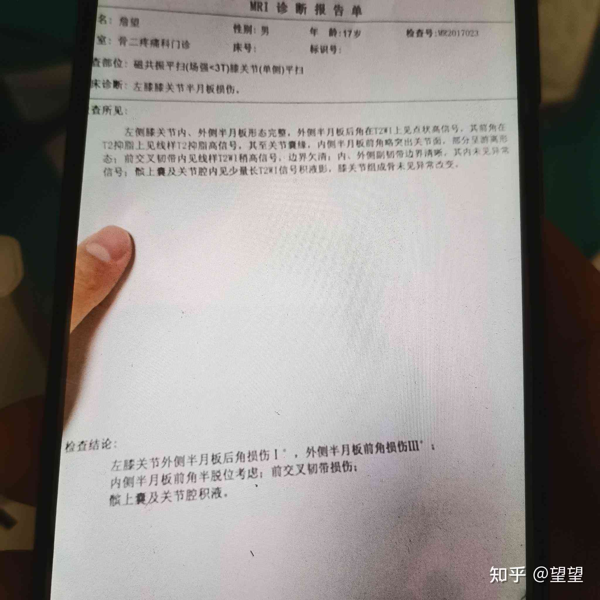半月板撕裂做手术了能认定工伤吗