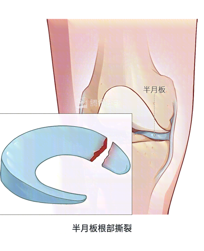 半月板撕裂怎么认定工伤
