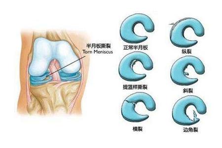 膝关节半月板磨损：工作原因导致的损伤能否被认定为工伤？